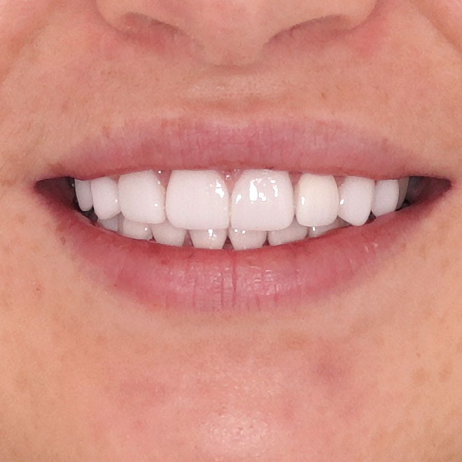 porcelain veneers after 3Dental